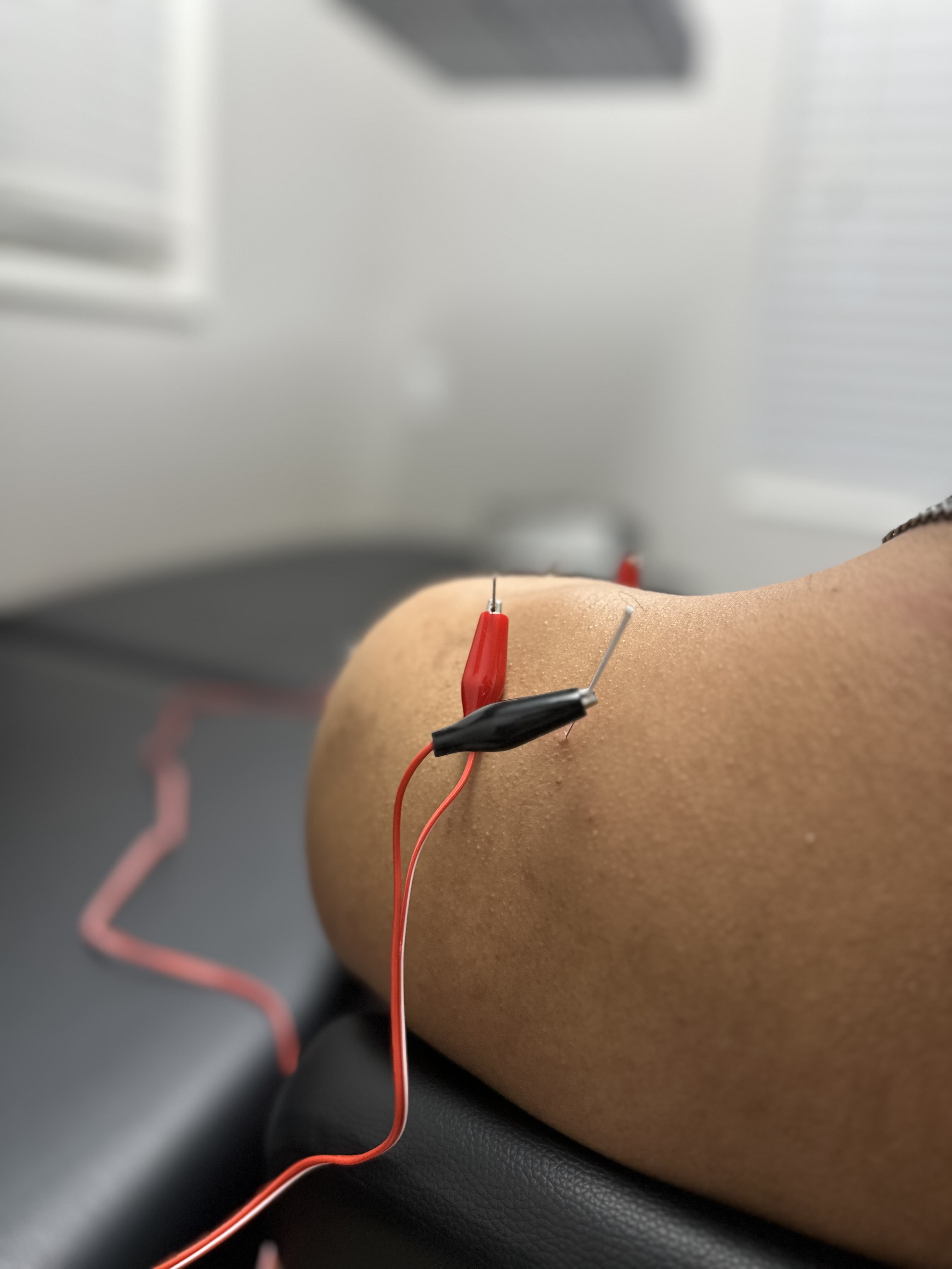 Electrical Stimulation